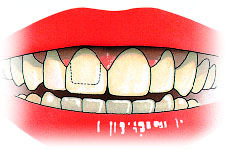 Poorter tandartsen: Kronen en bruggen