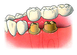 Poorter tandartsen Zoetermeer: Kronen en bruggen
